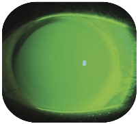 Scleral ICD Lens